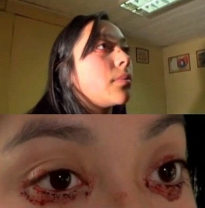 붉은 눈물 흘리는 여성, 눈가에 '피범벅'…치료법은?