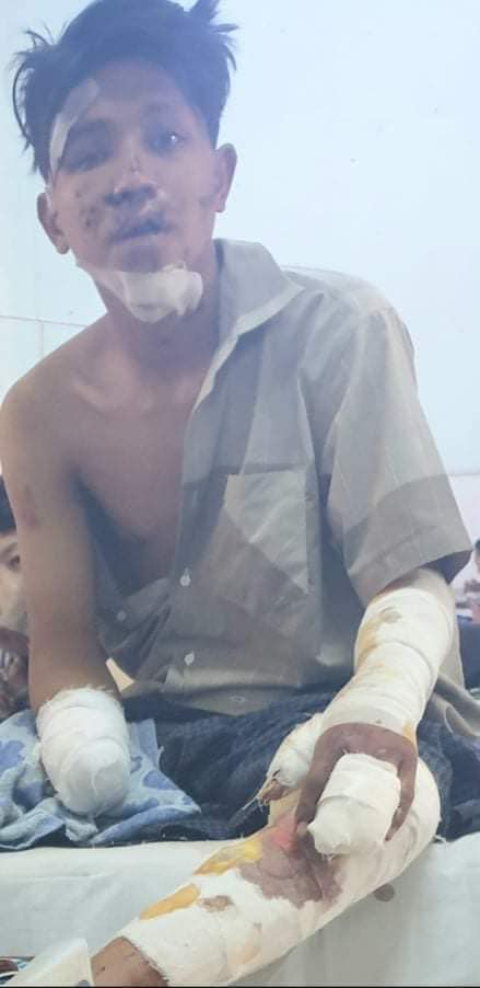 지난 3월 군부 총격으로 팔 절단 수술을 한 미얀마 청년 흘랸 표 아웅. 〈사진=본인제공〉