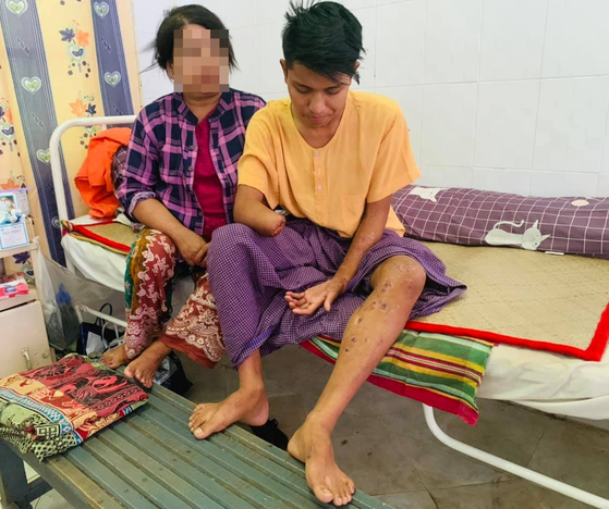 지난 3월 군부 총격으로 팔 절단 수술을 한 미얀마 청년 흘랸 표 아웅(오른쪽). 다리엔 총자국도 선명하게 남았다.〈사진=본인제공〉